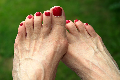 Un hallux valgus sur le pied d'une femme